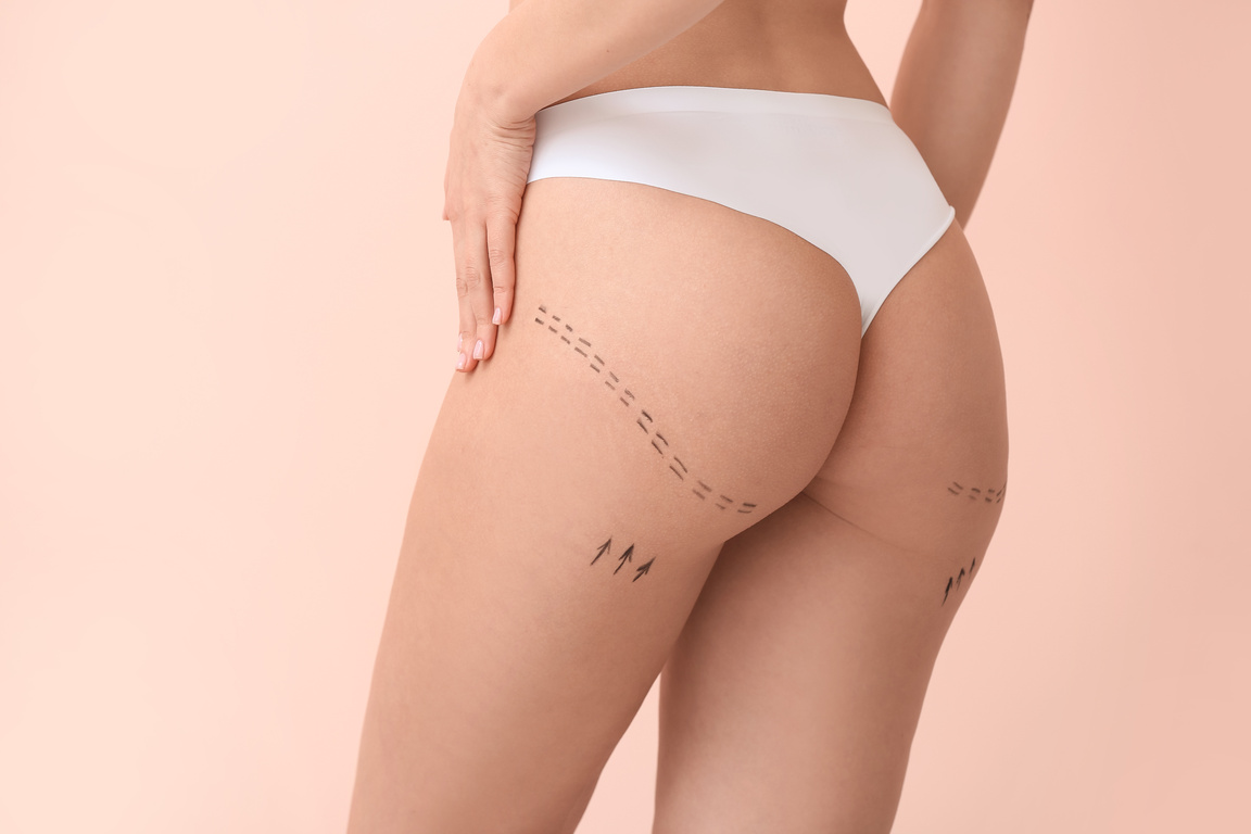 Young Woman with Marks on Her Hips against Color Background. Concept of Plastic Surgery